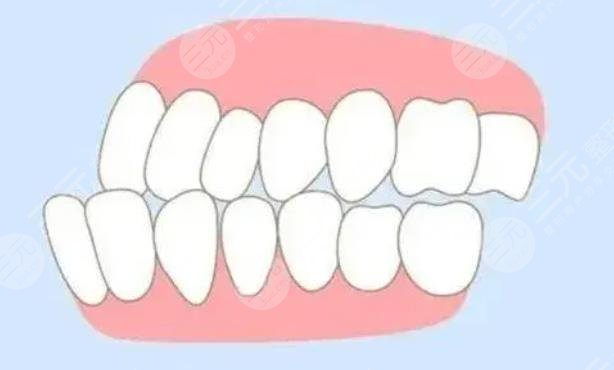地包天牙齿矫正