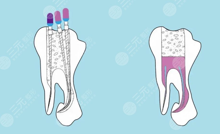 牙齿烂了一个洞是什么原因造成的?