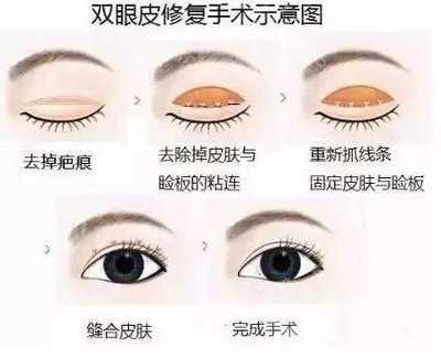 刘晓伟医生双眼皮修复案例分享