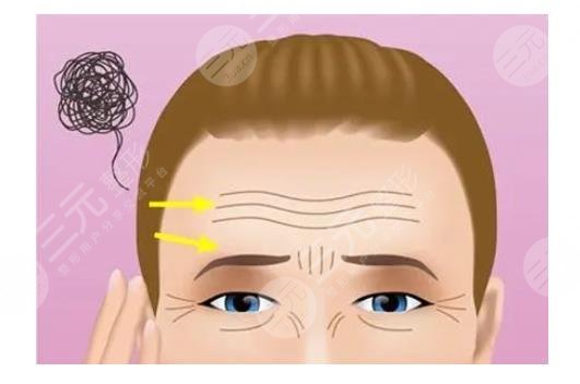 抬头纹可以去除吗3种有效方式盘点激光注射等优势分析