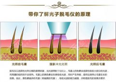 脱毛的方法有哪些？4种网友种草方式盘点！激光、脱毛膏等哪个更好？