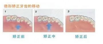 牙齿矫正过程