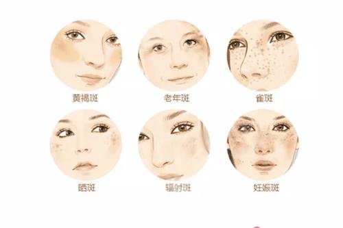 怎样祛斑快有果?