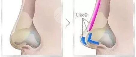 隆鼻术后第七天