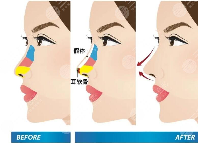 隆鼻1到7天恢复过程图解