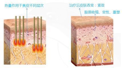热玛吉手术