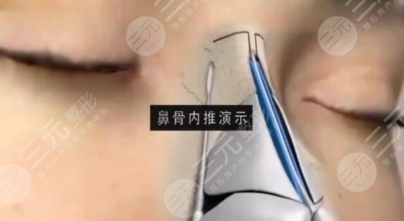 鼻骨内推前后果分享，一个小小的改变就能让颜值直接飙升好几个level~