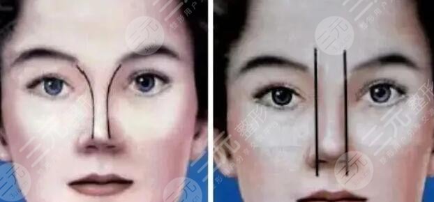 鼻骨内推手术术前