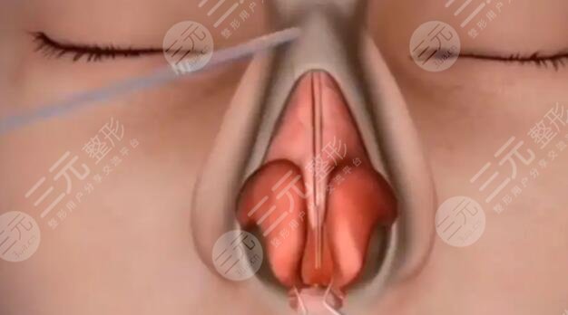 鼻部整形手术的常见方法有哪些?