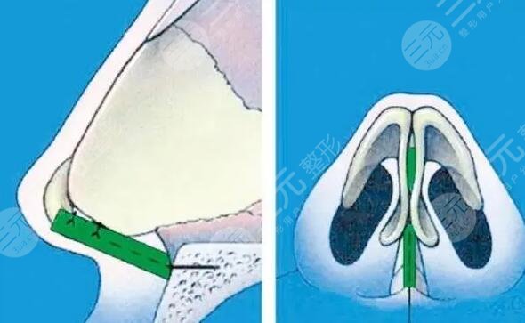 鼻部整形有风险吗?