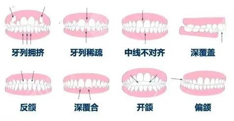 牙齿矫正适合人群