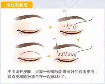 双眼皮手术过程