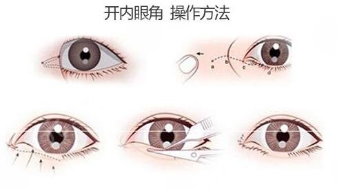 洛阳市中心医院双眼皮手术做的好吗?