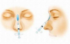 玻尿酸填充鼻子能维持多久？注射隆鼻小课堂！科普手术常识！