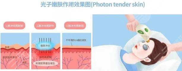 光子嫩肤作用果