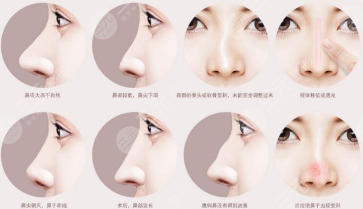 鼻子有点歪怎么办?可以调整吗?