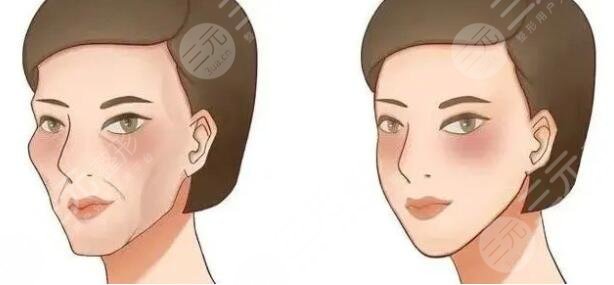 全脸脂肪填充5到10天照片