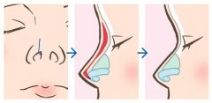 隆鼻假体取出来后能恢复到以前吗？修复手术科普！真的有“后悔药”吗？