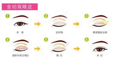 全切双眼皮手术