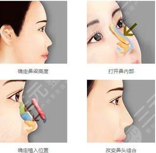小翘鼻案例|妈生鼻自然款的鼻子图片