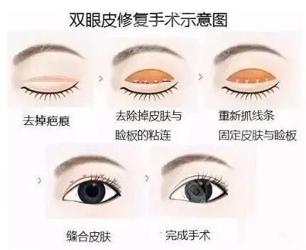 北京双眼皮修复案例