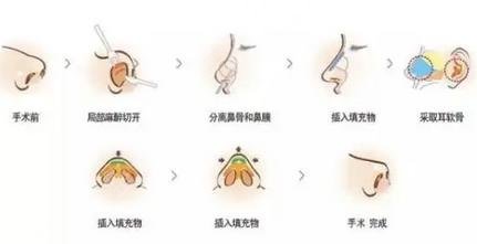 隆鼻手术