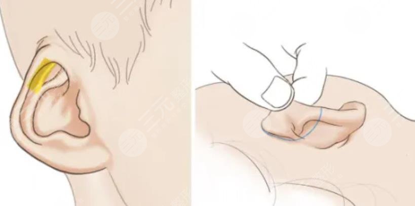 后天性耳廓缺损