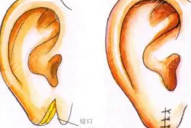 后天性耳廓缺损