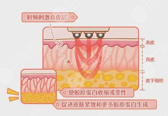 热玛吉果图