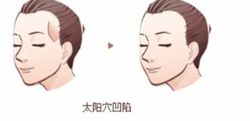 太阳凹陷填充手术缓解当日