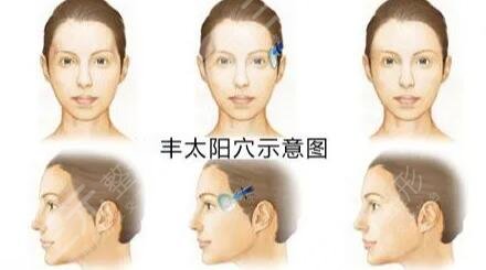 太阳凹陷填充手术后一个月