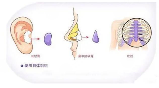 假体隆鼻科普