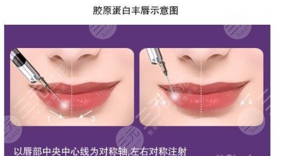 唇形不好看怎么矫正？整形果怎么样？注意事项+适合人群盘点！