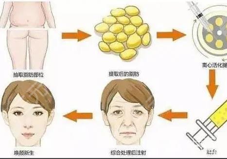 隆鼻哪种材料果好 1、自体脂肪隆鼻