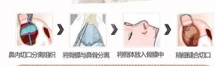 超体隆鼻的注意事项