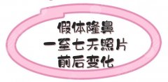 假体隆鼻一至七天照片前后变化:肿胀淤青减轻，鼻子立体感也出来了！