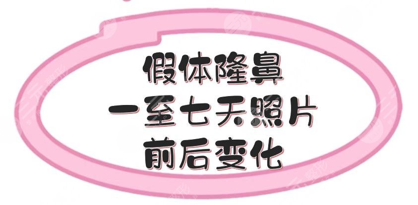 假体隆鼻一至七天照片前后变化