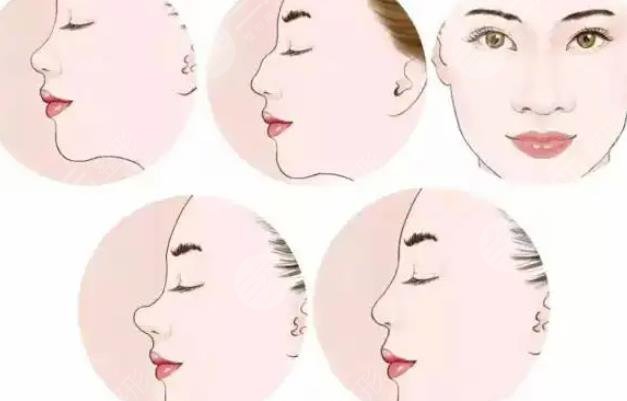 假体取出后如何护理