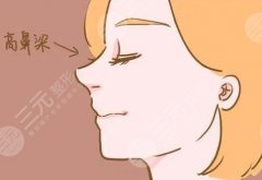 做耳软骨隆鼻有后遗症吗？耳软骨隆鼻的优点是什么？收下这份术后分享