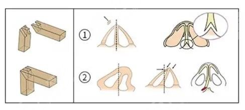 射极峰膨体的三种型号价格、区别盘点