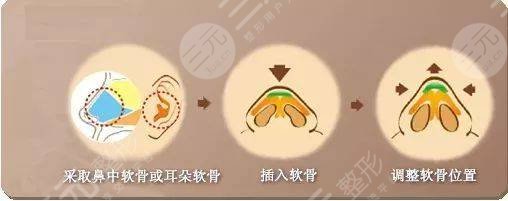单侧耳软骨隆鼻和双侧有什么区别?哪个好?