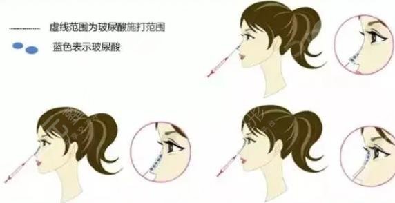 网友玻尿酸隆鼻亲身经历|案例分享  术前