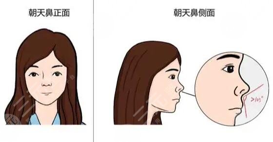 朝天鼻纠正整形手术费用多少钱?一个手术让你拥有爆款颜值!对比强烈~