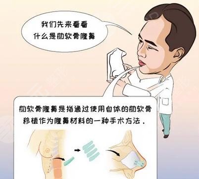 超肋骨鼻有哪些优势?