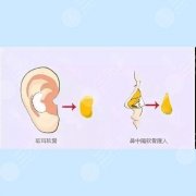 耳软骨隆鼻恢复过程图片果|案例展示:妈生鼻无疑了！告别平板脸型~