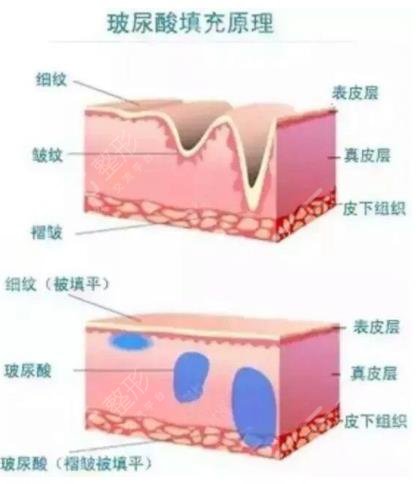 玻尿酸