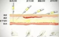宝尼达隆鼻可以维持多久？附术后注意事项，拯救你的脸只需1针！