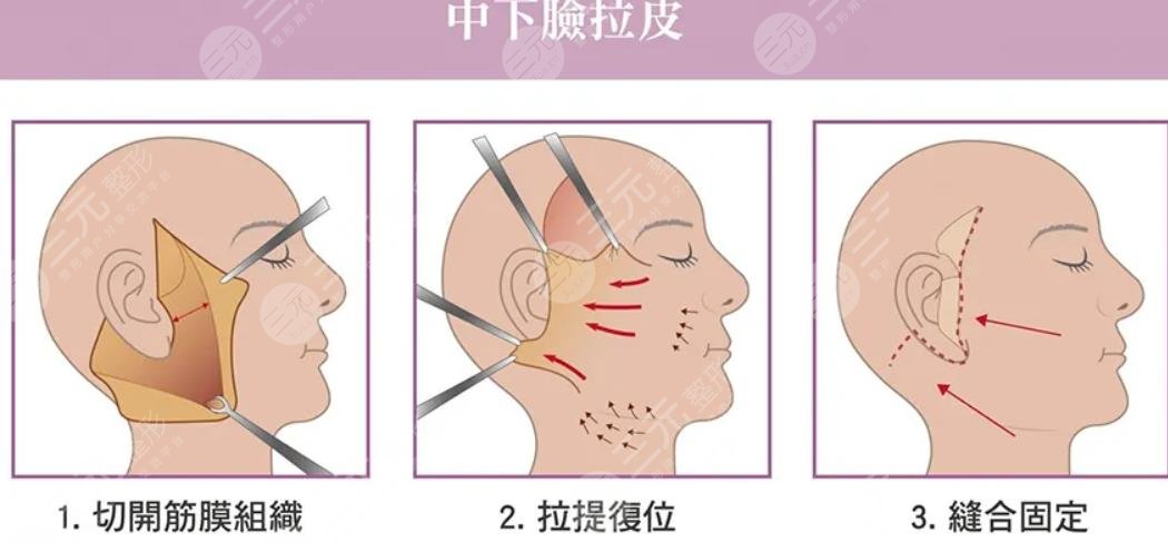 拉皮手术后注意事项有哪些