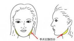 磨骨和削骨的区别是什么?知识大科普,推荐3家具有资质的医院 磨骨和削骨的区别是什么?知识大科普,推荐3家具有资质的医院