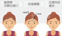 拉皮手术十年后的情况分享，比同龄人“年轻”不少
